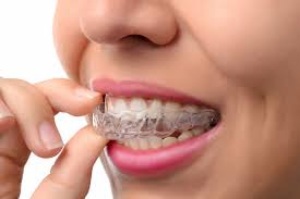 Everything You Need to Know About Ceramic Braces